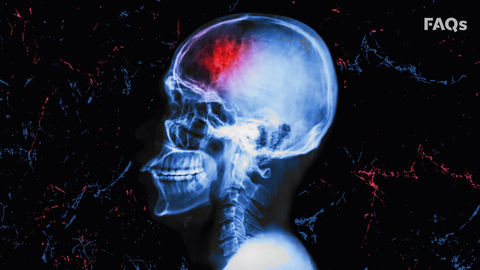 1920x1080 Luke Perry’s death: Strokes don’t just kill the elderly