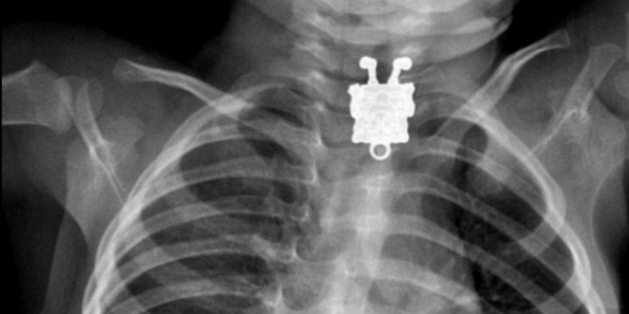 1600x900 SpongeBob SquarePants Turns Up in Child's X-Ray - ABC News