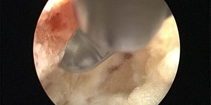 1280x1024 The “inside out” transforaminal technique to treat lumbar spinal