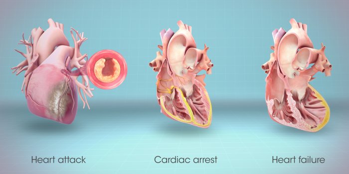 1920x1080 Heart Attack, Cardiac Arrest and Heart Failure..They are all different
