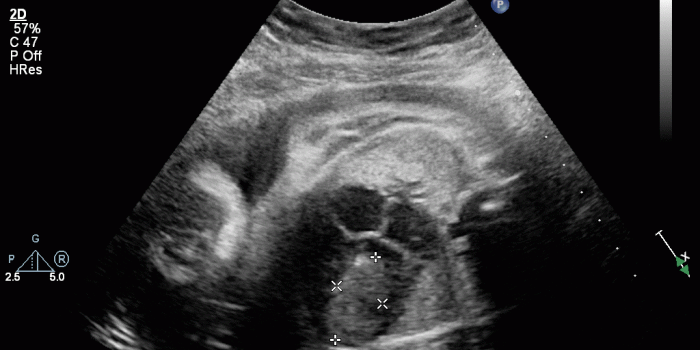 1024x768 Number 16-02: Neonatal Cardiac Mass: An Example of the Utility of