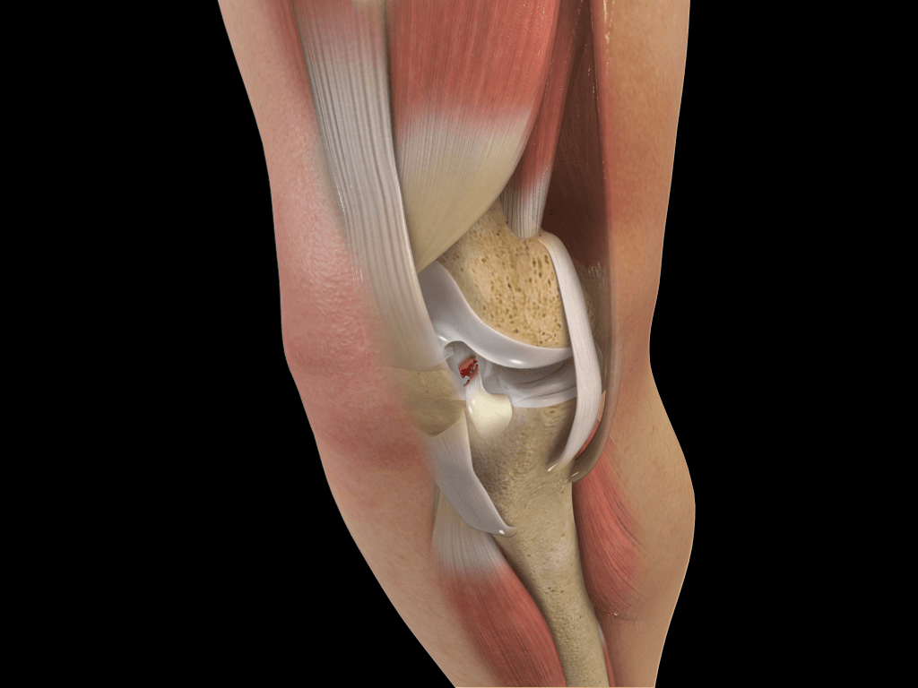 1024x768 ACL Tears | New England Orthopedic Surgeons, Massachusetts MA