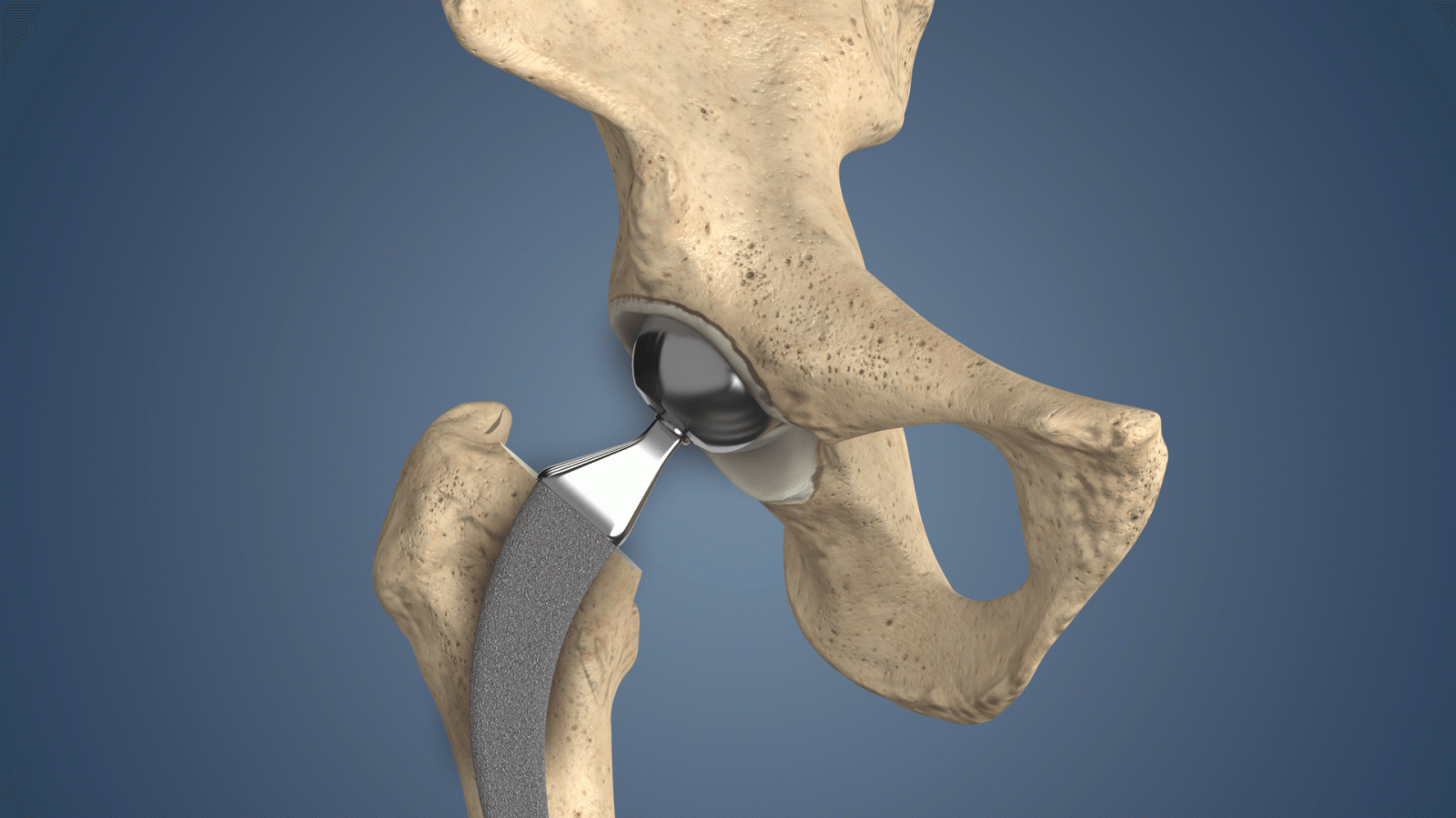 1920x1080 Partial Hip Replacement | Aspen Orthopedic Specialists | Brookfield, WI
