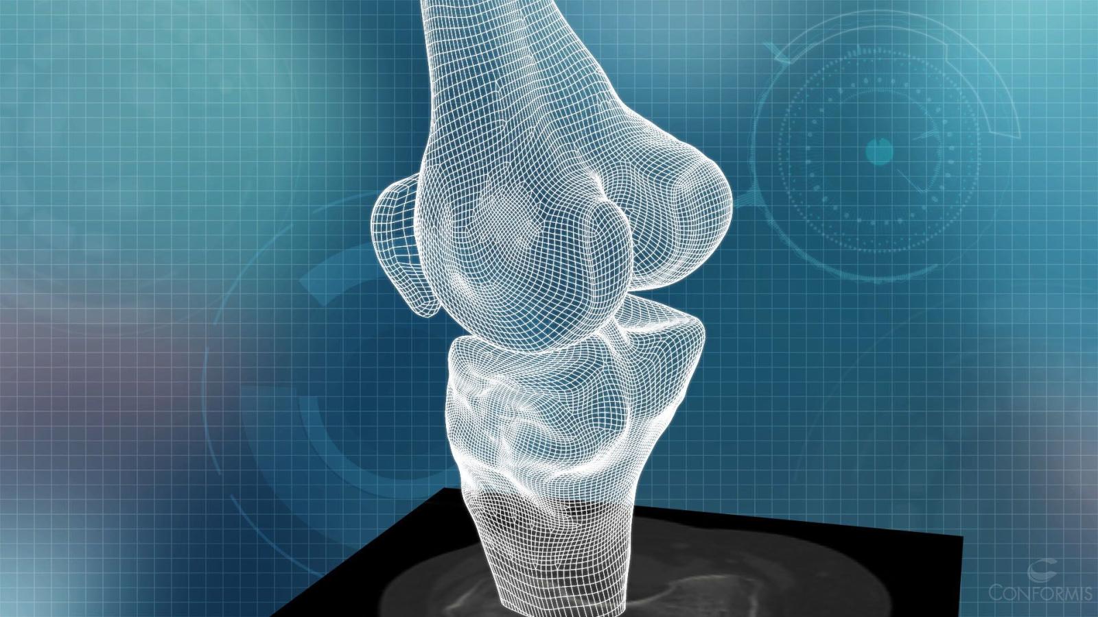 1920x1080 Centura Orthopedics now offers 3D-printed replacement joints | The