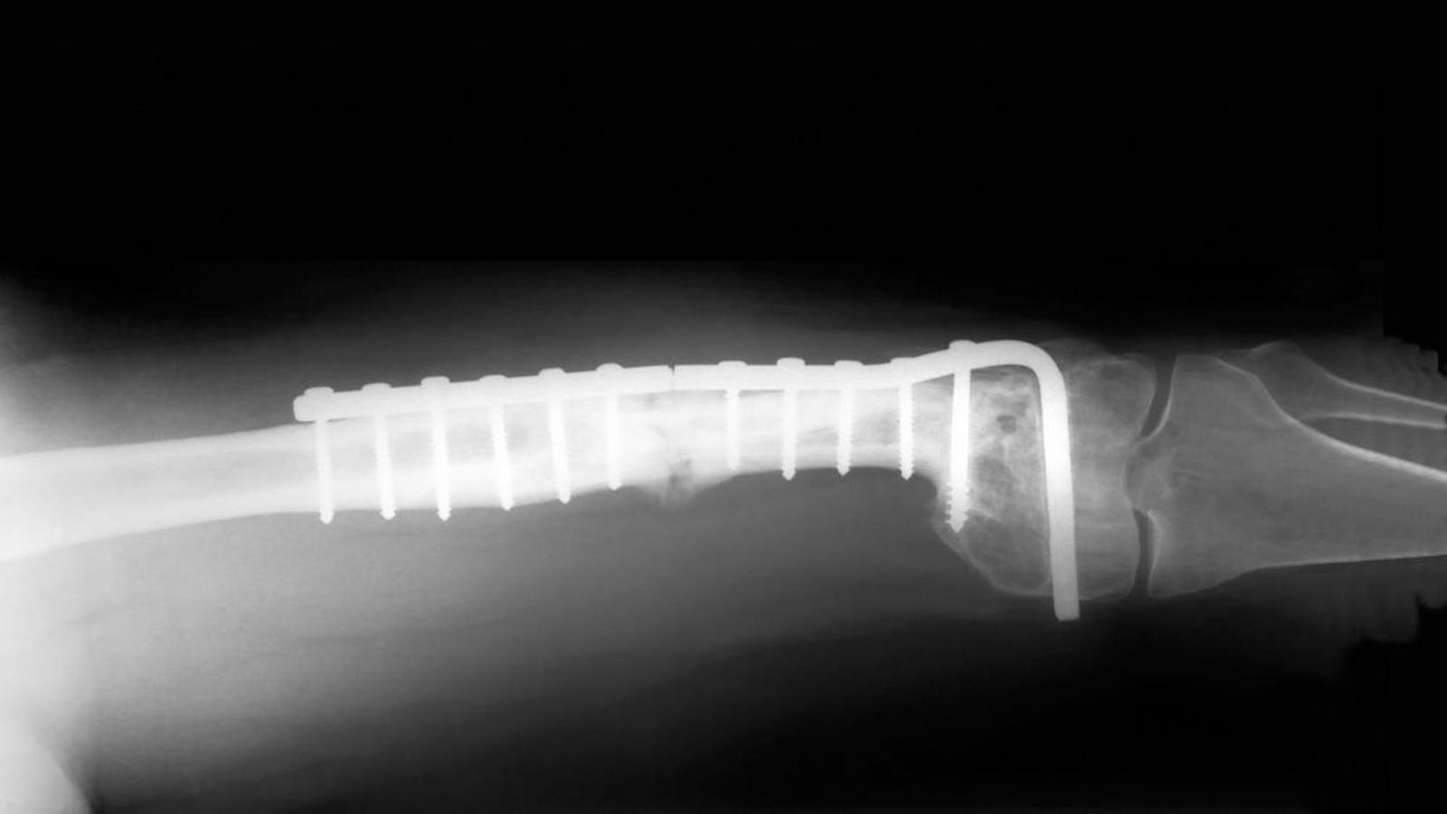 1920x1080 Tiny sensor transmits data from orthopedic implants