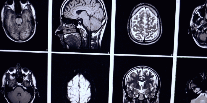 1920x1080 Multiple MRI brain scan, x-ray images Stock Video Footage - Storyblocks  Video