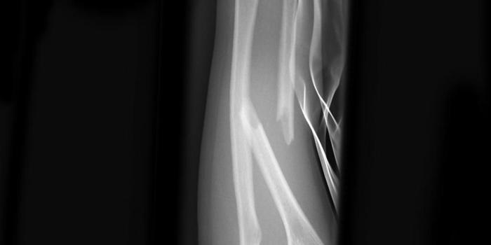 1024x1024 Monteggia fracture | Radiology Case | Radiopaedia.org